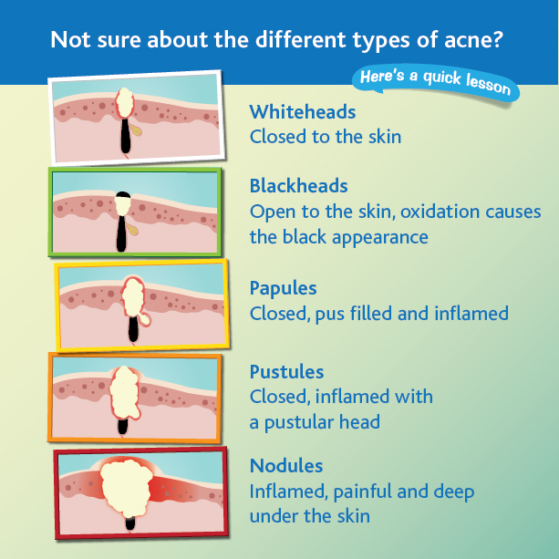 Could acne be an allergic reaction